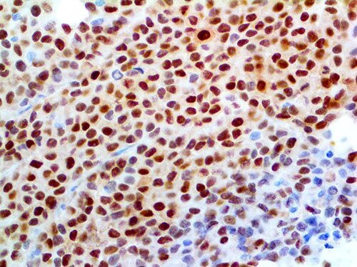 IHC of MiTF on an FFPE Melanoma Tissue